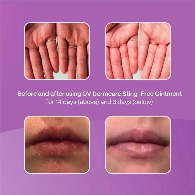 QV Dermcare Sting-Free Ointment - 100g Tube - Image 5